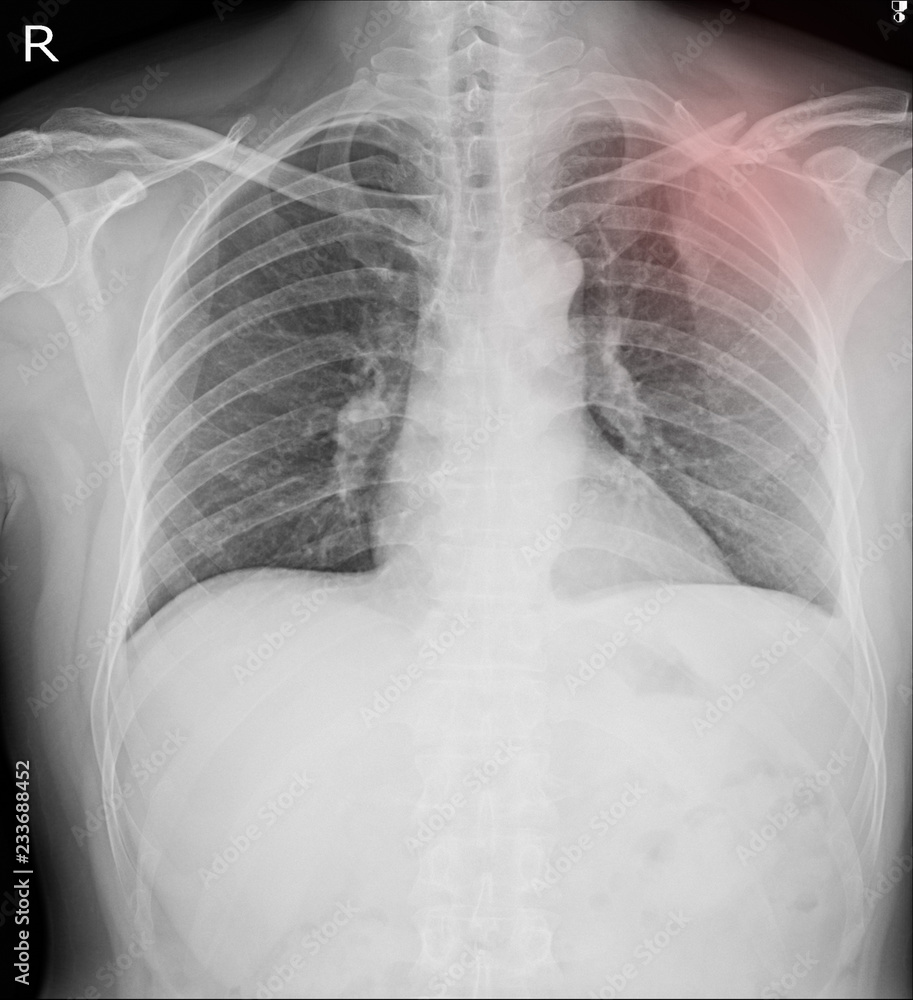 posterior rib fracture