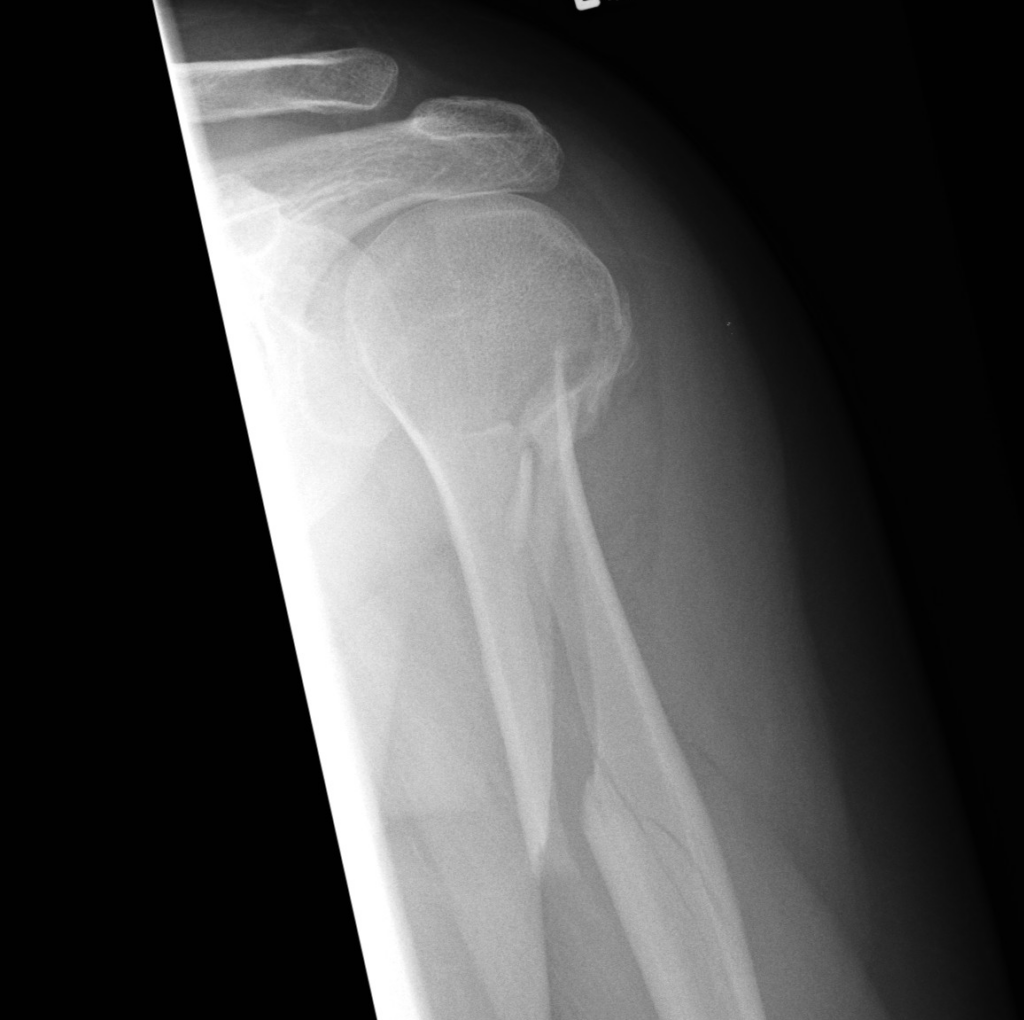 abusive fractures in children