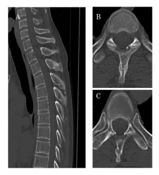 abusive fractures in children