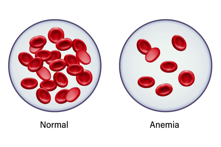 Anemia vs Normal